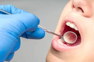 Qué es la prevención de caries