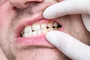 Cómo prevenir los diferentes tipos de caries dentales
