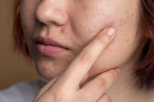 Tratamientos caseros para tratar el acné facial