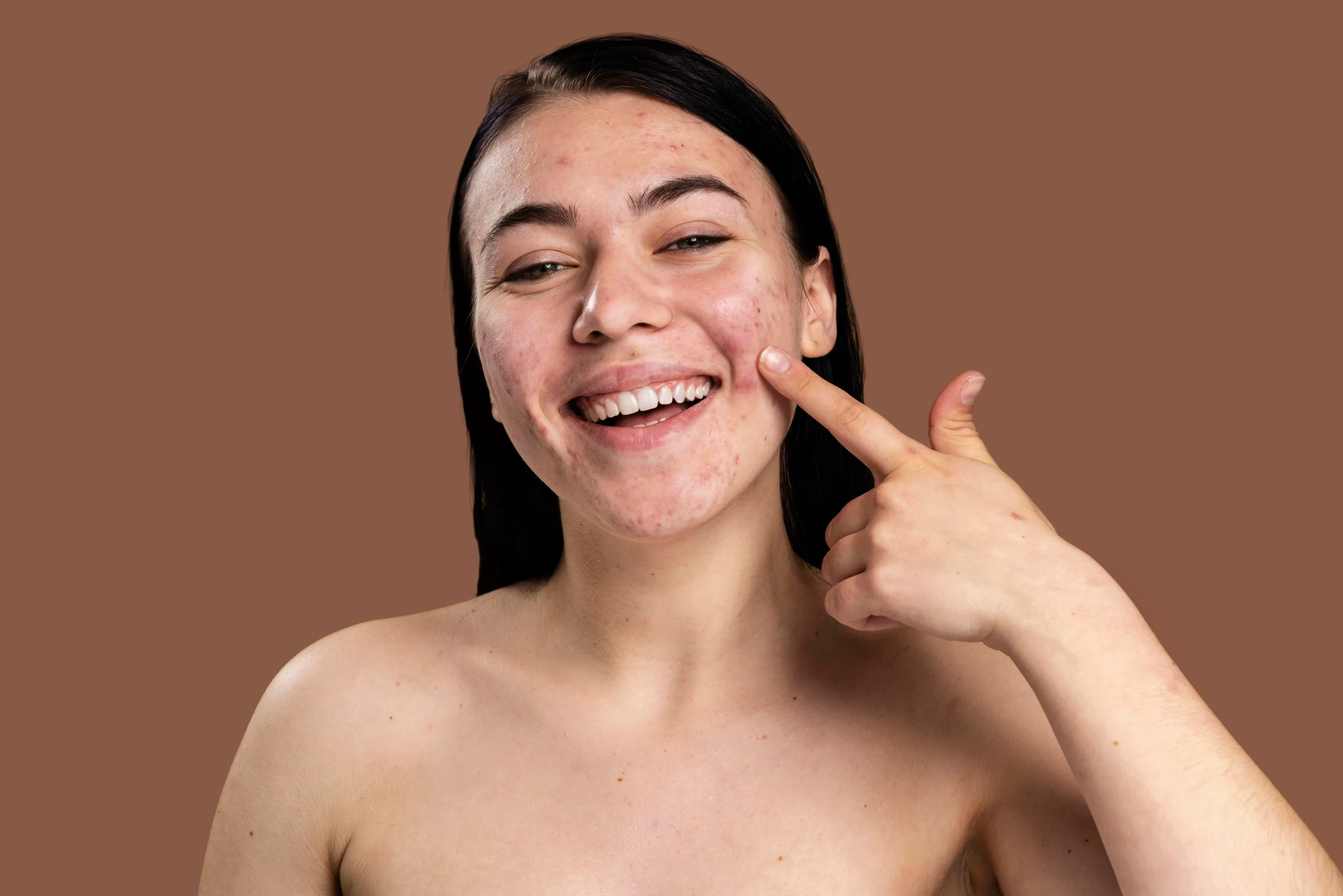 Rutina cicactrices en la cara de acné